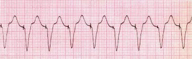 Pacemaker Malfunction. Pacemaker-mediated tachycar
