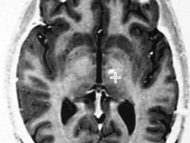 Axial, fast spin-echo inversion recovery magnetic