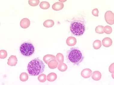 Hairy Cell Leukemia: Practice Essentials, Pathophysiology