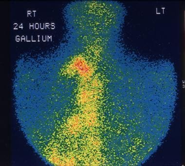 Non-Hodgkin Lymphoma (NHL): Practice Essentials, Background, Pathophysiology