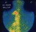 Non-Hodgkin Lymphoma (NHL)