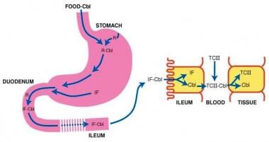 Pernicious anemia. Cobalamin (Cbl) is freed from m