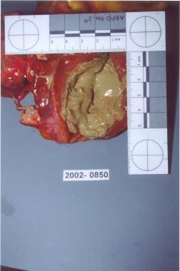 Myocardial abscess (gross). 