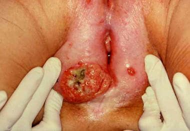 A large squamous cell carcinoma of the vulva. Note