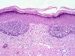 Basal Cell Carcinoma