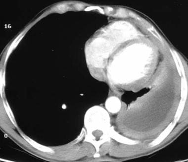 Mesothelioma Practice Essentials Background Etiology