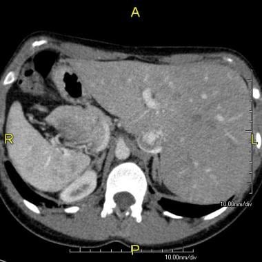 Axial CT image showing situs inversus (liver and i