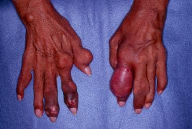 Gout. Chronic tophaceous gout in untreated patient