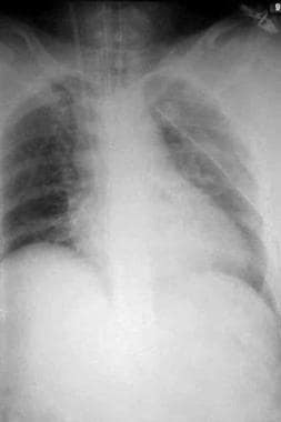 Postoperative chest radiograph in a 53-year-old wo