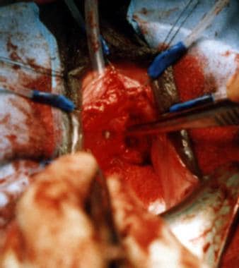 Urethral Diverticula Treatment & Management: Approach Considerations,  Surgical Therapy, Intraoperative Details