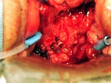 Supratrigonal vesicovaginal fistula. Surgical sutu