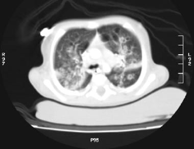 Chest CT in 6-month-old male infant with newly dia
