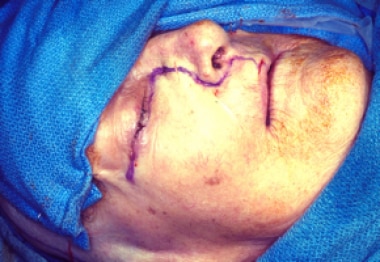A Weber-Ferguson incision is usually indicated for