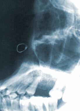 Septal Perforation - Medical Aspects: Background, Pathophysiology ...