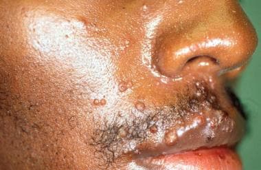Molluscum contagiosum rarely occurs on the face in