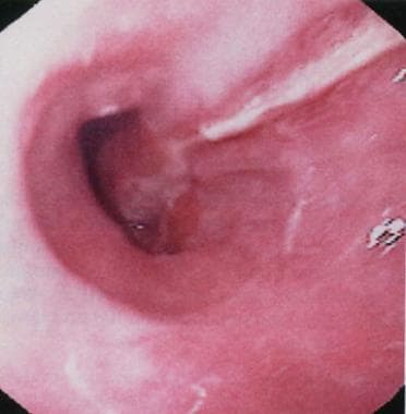 Mallory-Weiss Syndrome. Typical longitudinal mucos