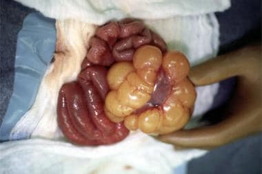 Multiple jejunal mesenteric cysts surrounding a lo