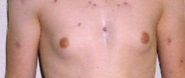 Adolescent male with gynecomastia and Klinefelter 