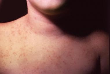 Skin lesions due to echovirus type 9 on neck and c