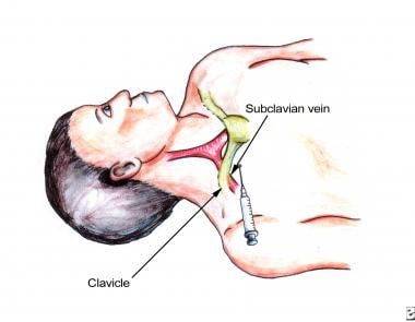 Percutaneous subclavian vascular access. Anatomic 
