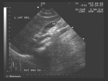Left lateral decubitus view of gallbladder. 