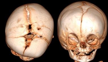 3D reconstruction of child with right unilateral c