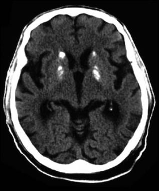 CT scan of a man who has Down syndrome confirmed b