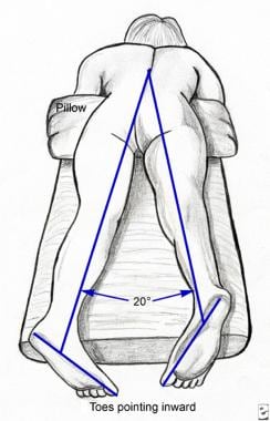 Patient in the prone position for caudal block tec