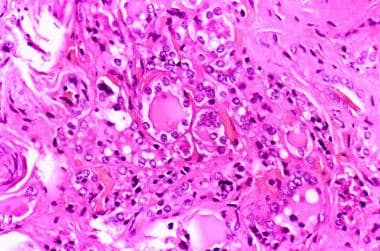 Histologic pattern of a mildly differentiated foll