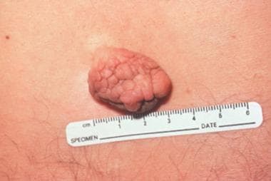 papillomatous lesions of skin