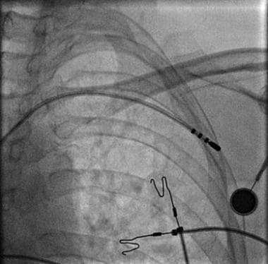 Fluoroscopic image demonstrates ablation catheter 