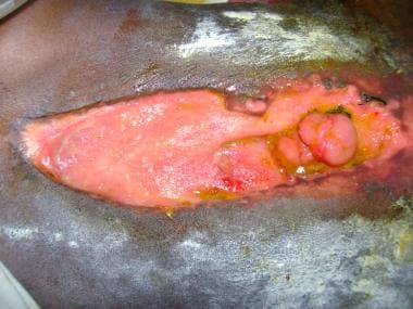 Eversion of mucosa in an enterocutaneous fistula, 