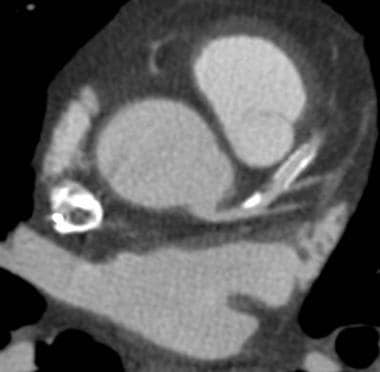 Coronary artery stent: Axial CT image demonstrates