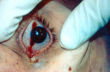 Tache noire develops when the eyelids are not comp