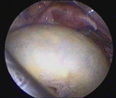 Ovarian cyst in a 10-month-old girl. The uterus an