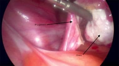 Transection du ligament infundibulopelvien gauche.