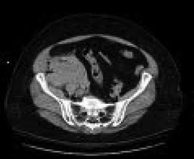 Contrast CT scan demonstrating retroperitoneal hem