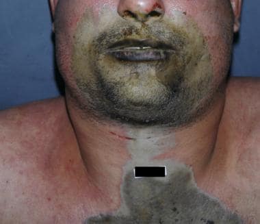 Acid burns, resulting from ingestion of sulfuric a