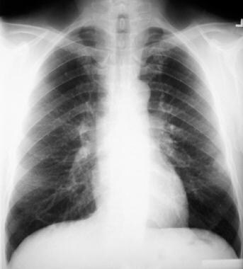 Coccidioidomycosis Imaging: Overview, Radiography, CT Scan