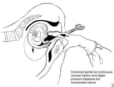 Uterine retroversion-incarceration has occurred. D