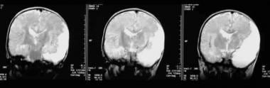 Postnatal coronal T2-weighted MRI images through t