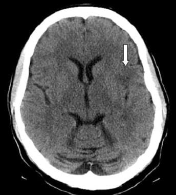 Noncontrast CT scanning was performed to evaluate 