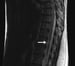 Multiple Sclerosis Spine Imaging