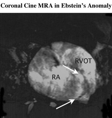 Coronal magnetic resonance angiogram acquired in a