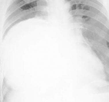 Frontal chest radiograph demonstrates a large calc