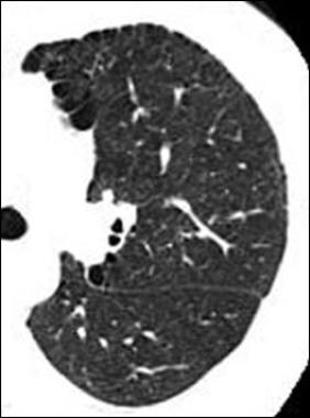 Emphysema Imaging: Overview, Radiography, Computed Tomography