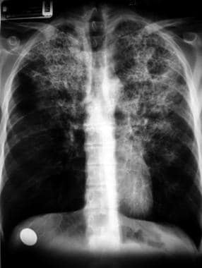 A posteroanterior chest radiograph from a patient 