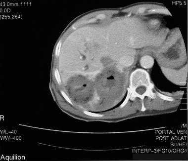 Contrast-enhanced CT scan in the same patient as i