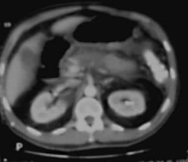 Acute pancreatitis. Pancreatic necrosis. Approxima