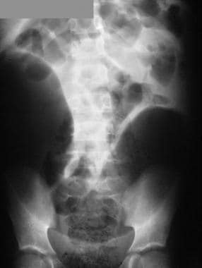 Supine abdominal radiograph in a 6-year-old child 